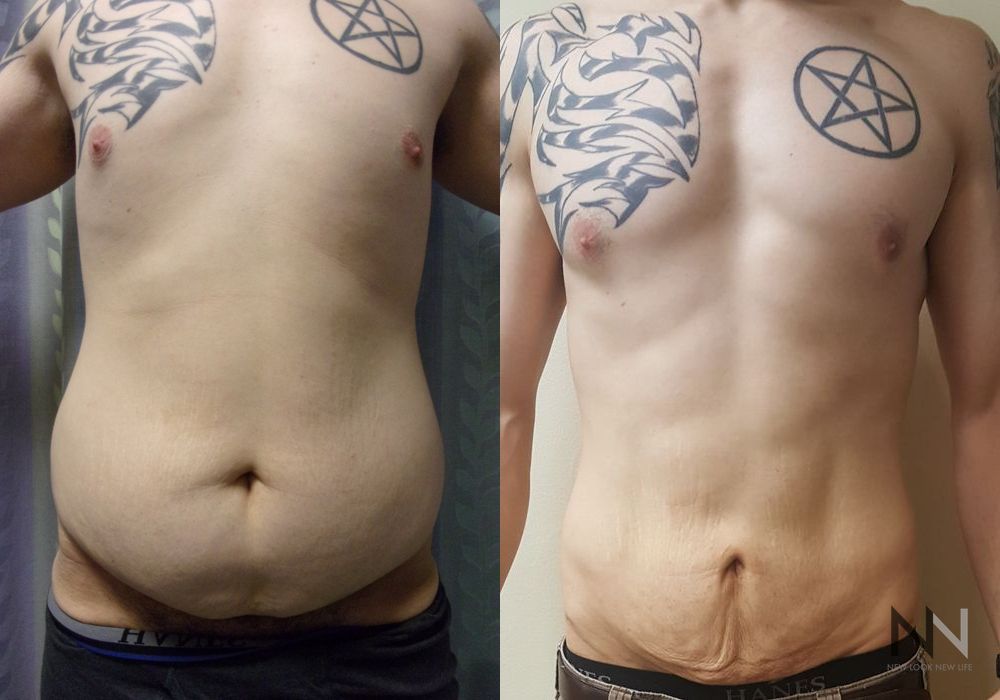 Male Liposuction - Case 87