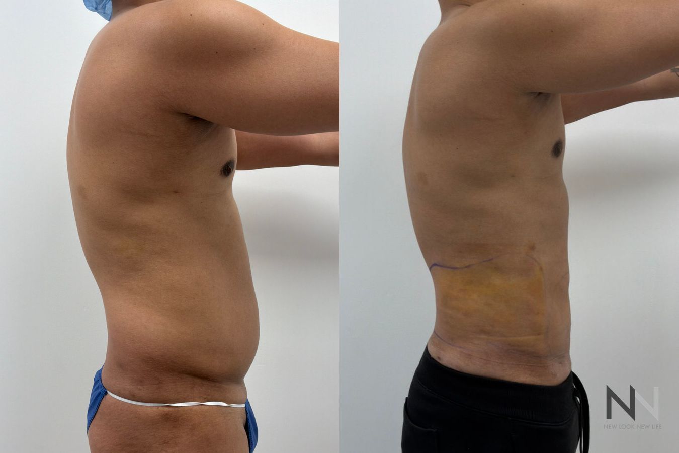 Male liposuction before and after showing refined abdominal, flank and lower back contours by Dr. Claudia Kim in NYC. - Angle 2