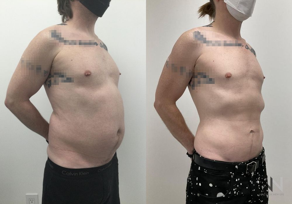 Male Liposuction - Thumbnail 2