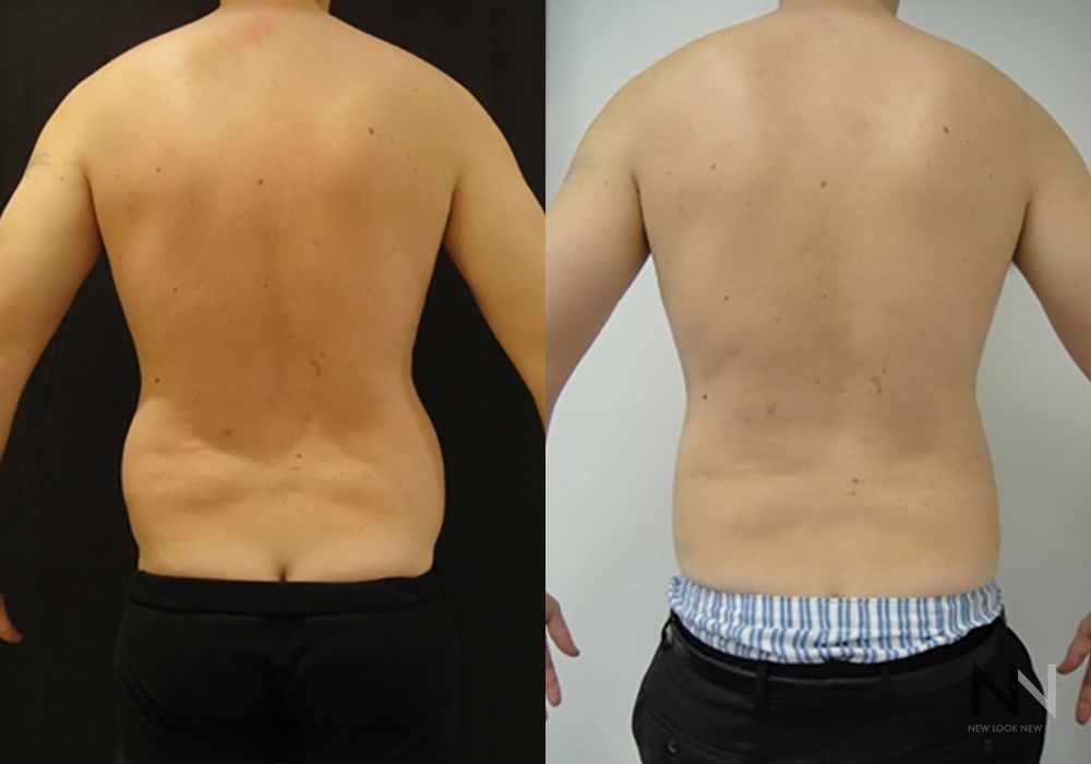 Male Liposuction - Case 85