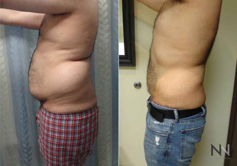 Male Liposuction - Thumbnail 2