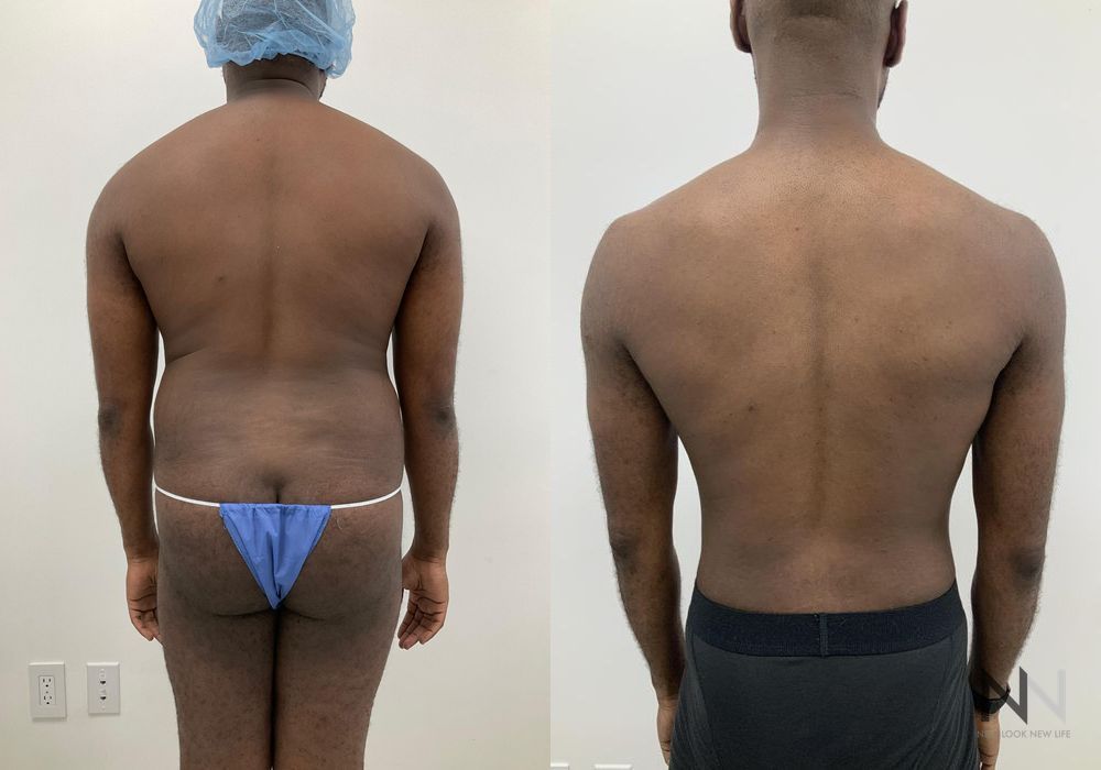 Male Liposuction - Thumbnail 2