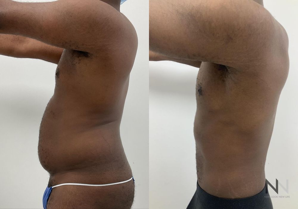 Before and after Gynecomastia case 21001 - Angle 6