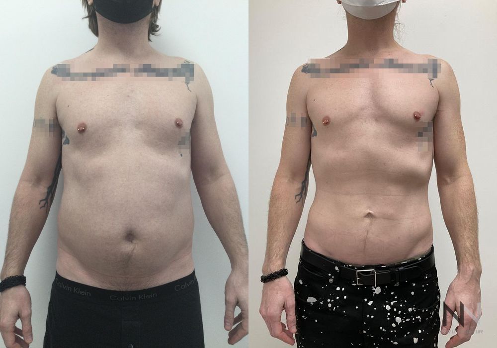 Male Liposuction - Thumbnail 3