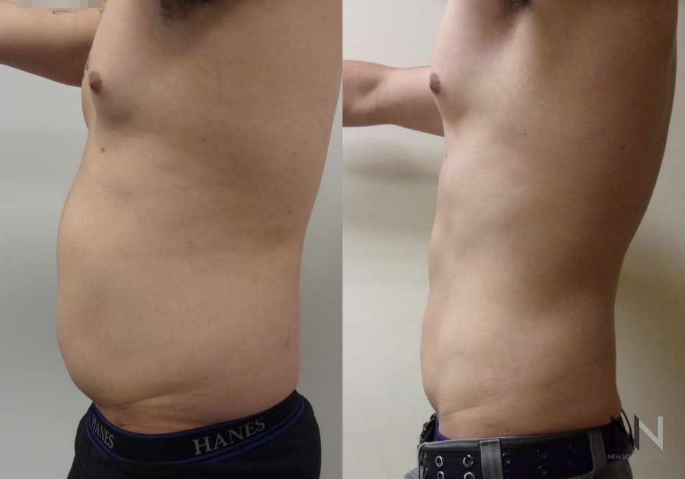 Male Liposuction - Thumbnail 2