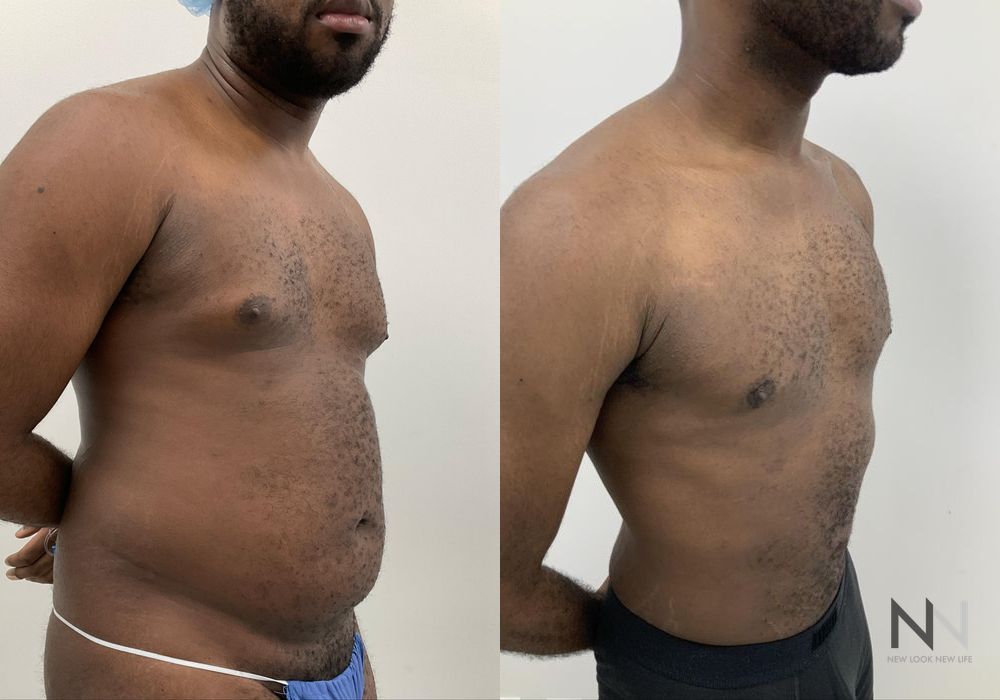 Before and after Gynecomastia case 21001 - Angle 3