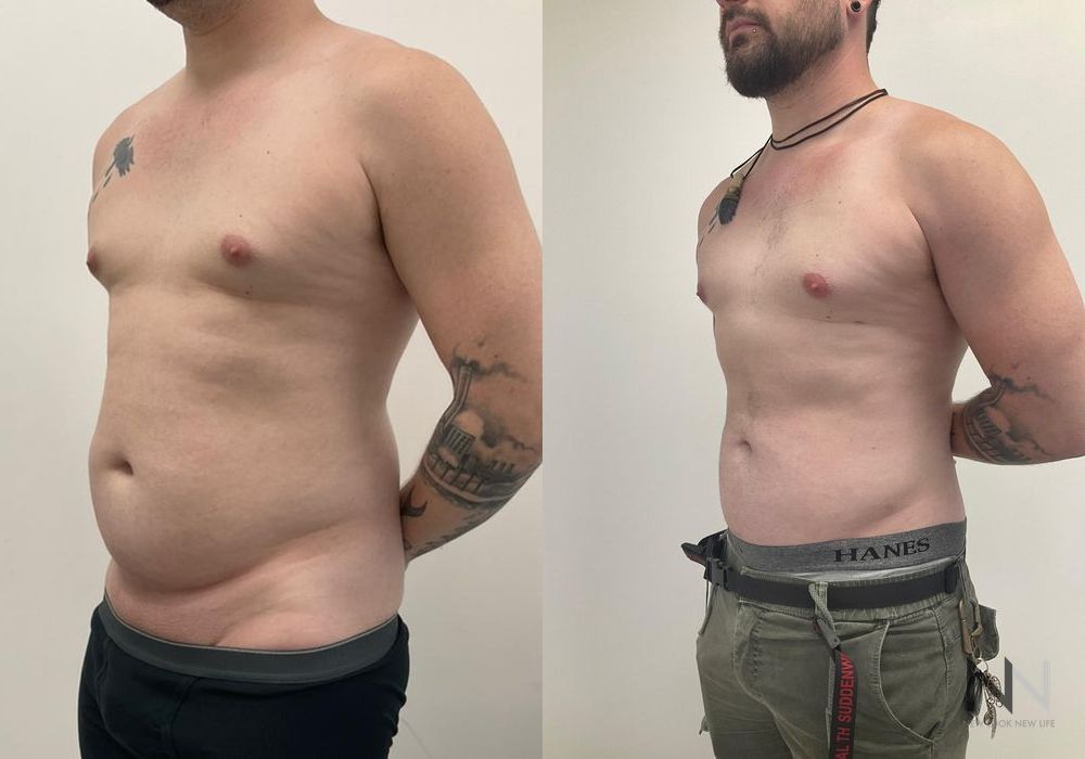 Male Liposuction - Thumbnail 2