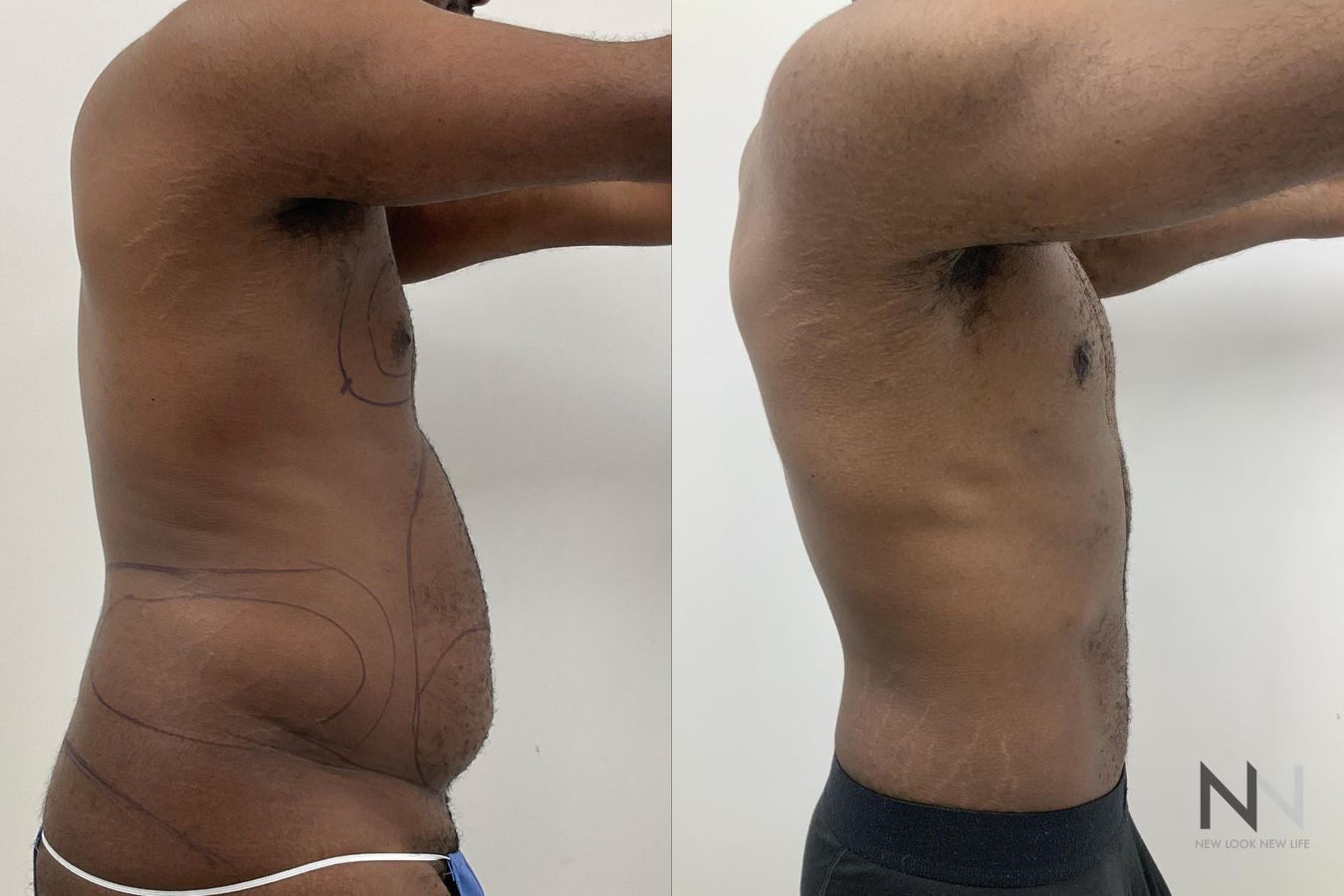 Gynecomastia surgery with Lipo 360 torso contour improvement - Angle 4