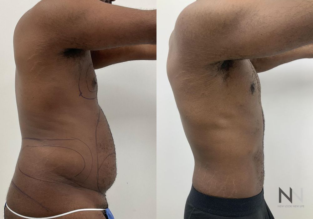 Before and after Gynecomastia case 21001 - Angle 4