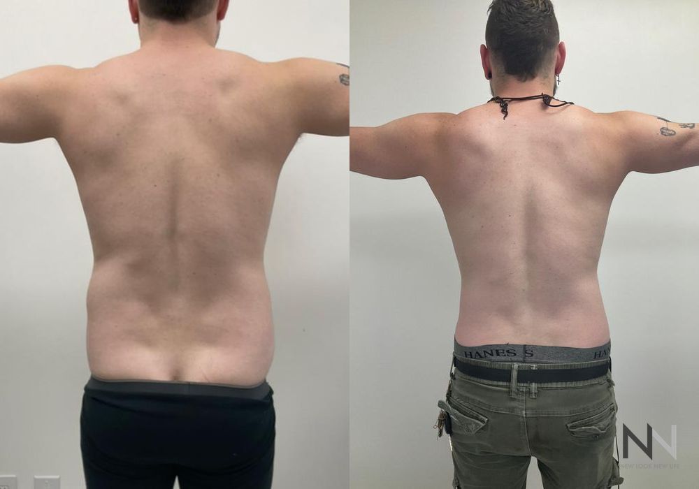 Male Liposuction - Thumbnail 3