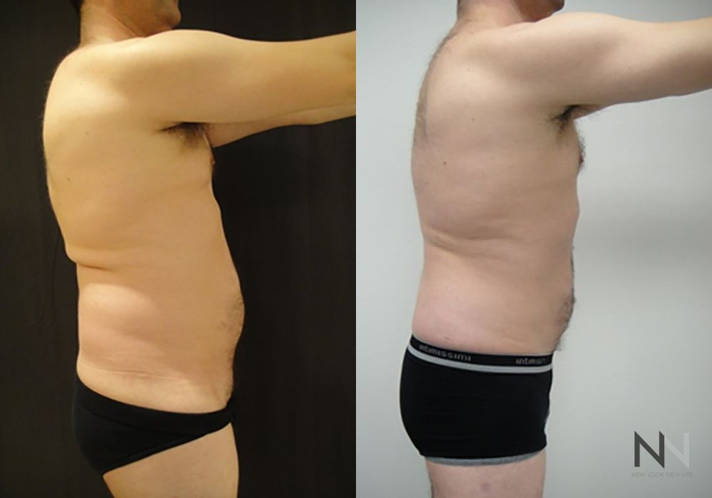 Male Liposuction - Thumbnail 2