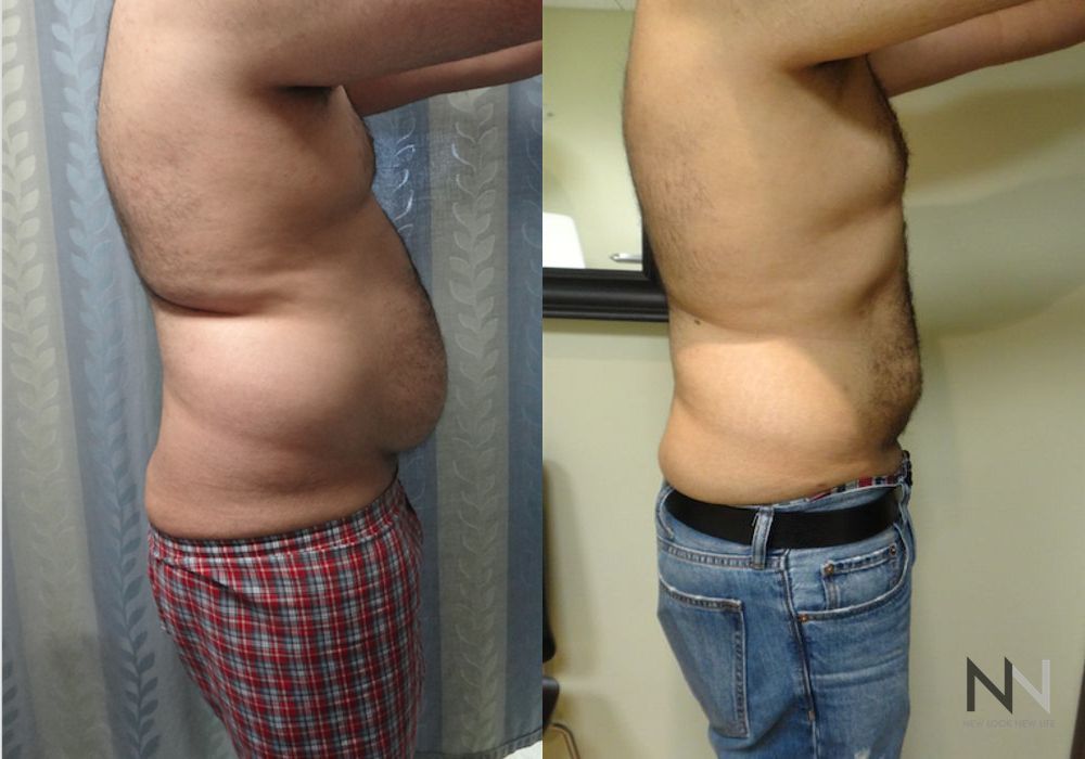 Male Liposuction - Thumbnail 3