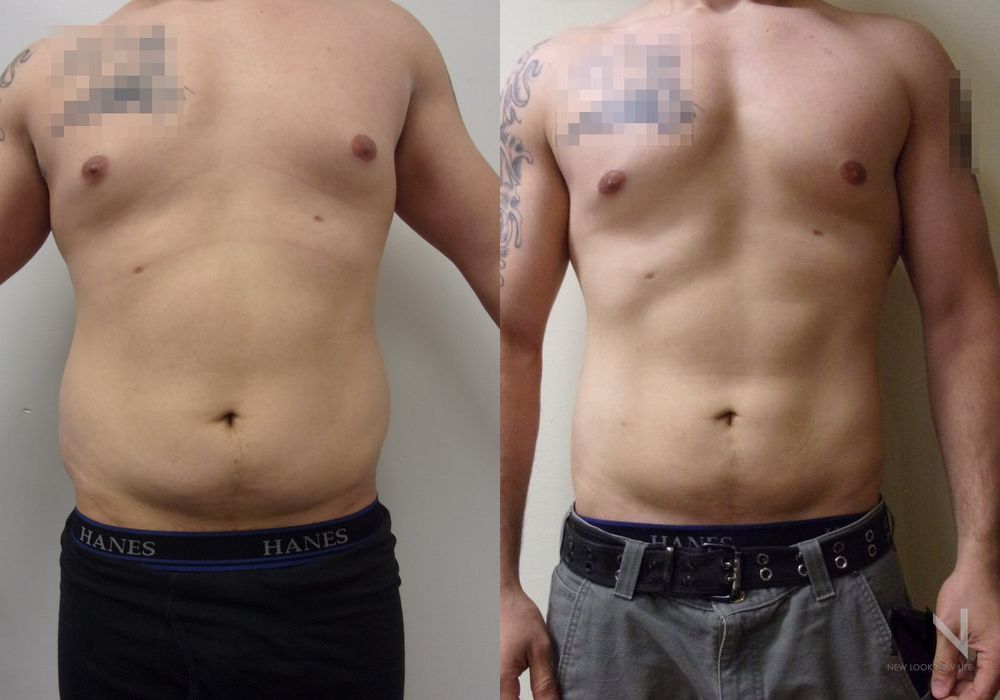 Male Liposuction - Case 80