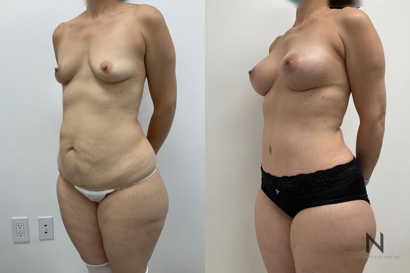 Breast augmentation and body contouring before and after - Angle 5
