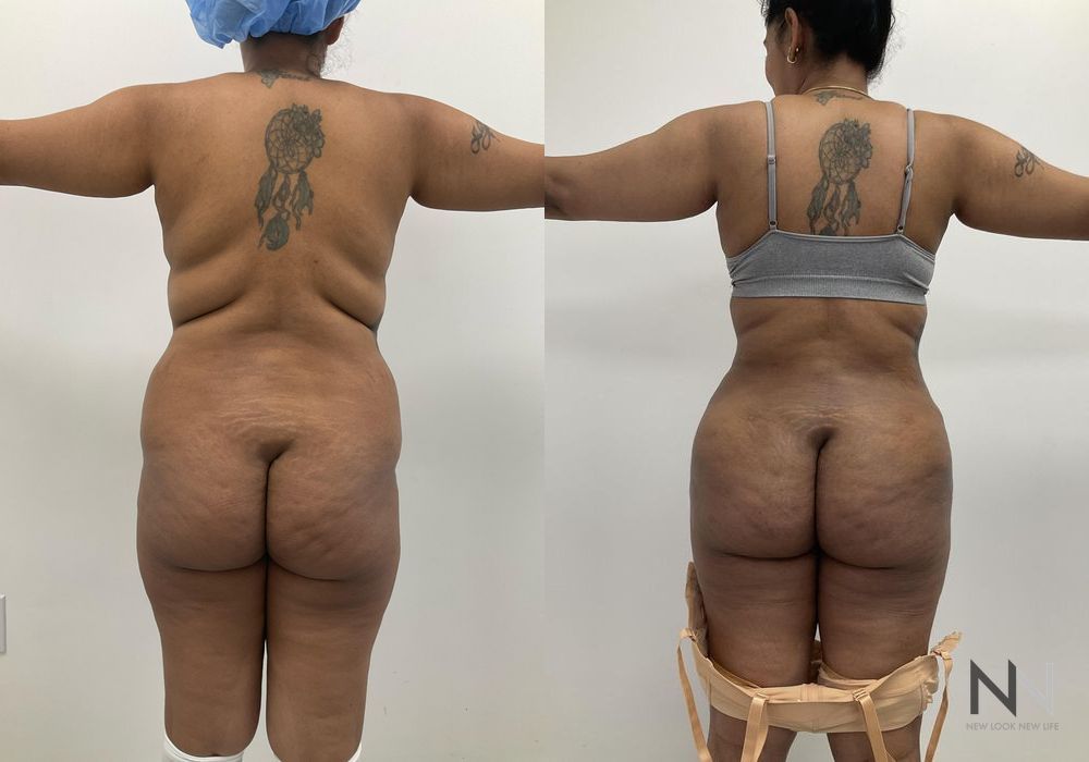 Mommy Makeover - Case 2077