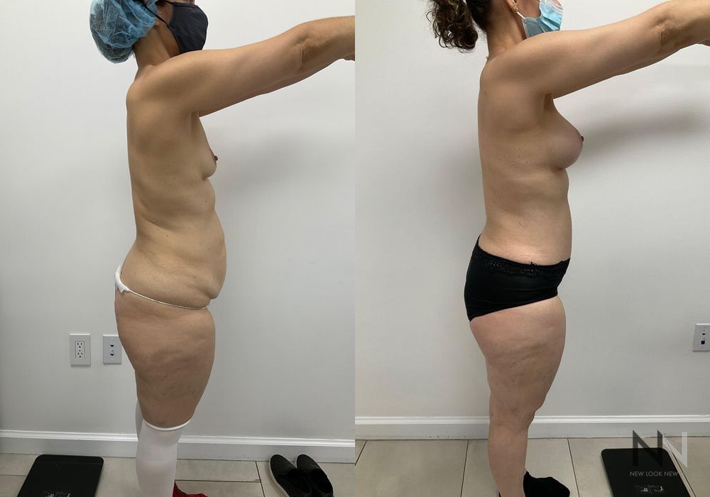 Mommy Makeover - Thumbnail 4