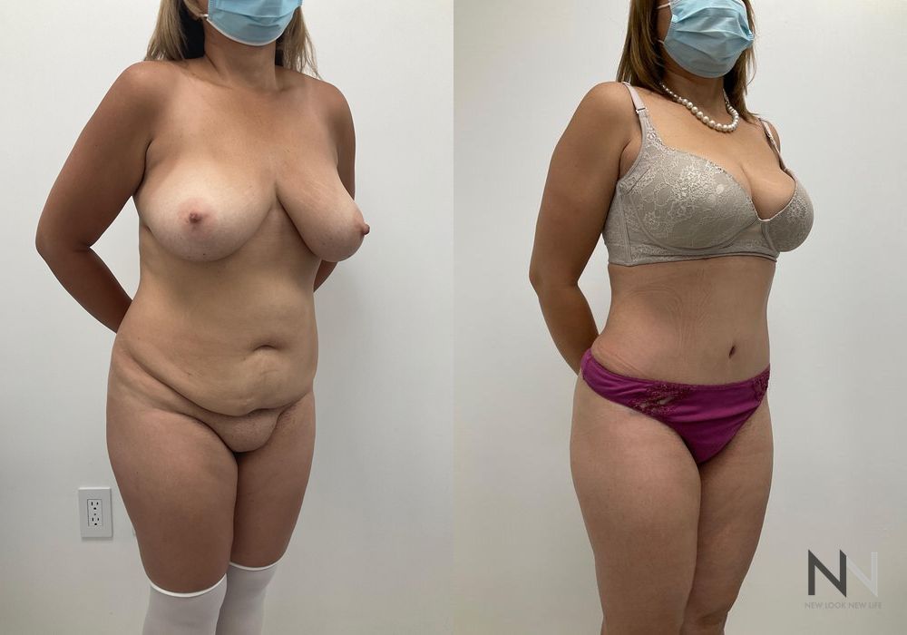 Mommy Makeover - Case 2081