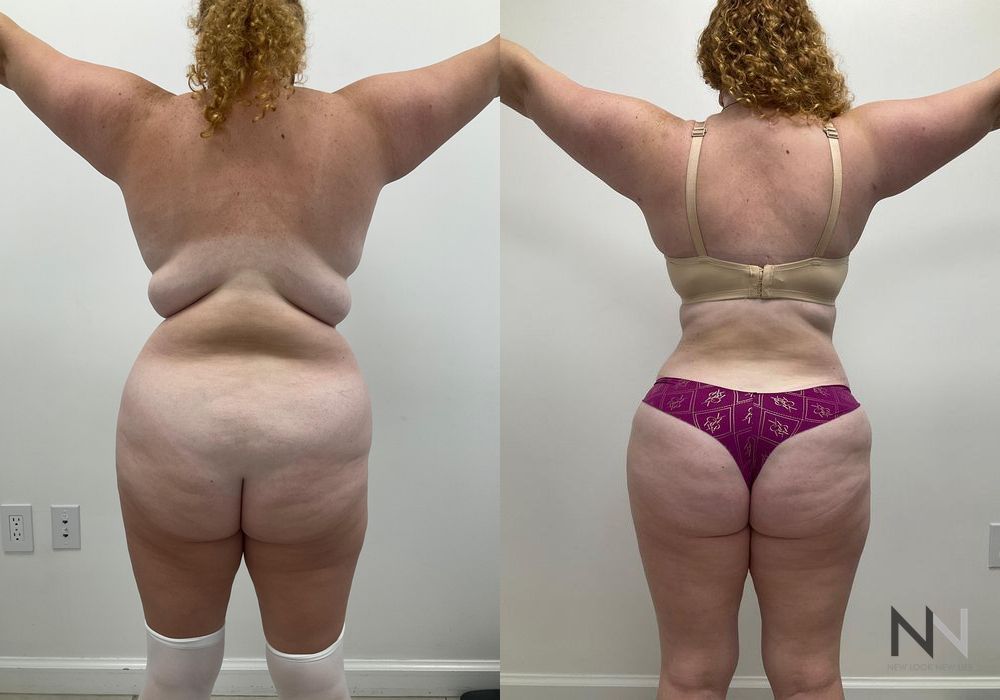 Mommy Makeover - Thumbnail 2