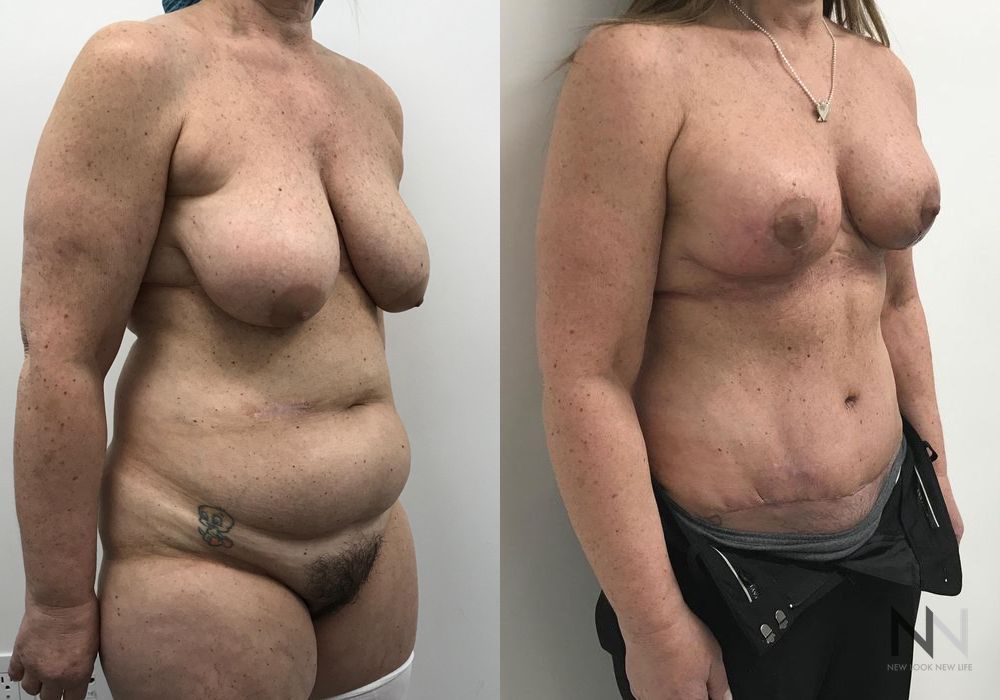 Mommy Makeover - Thumbnail 4