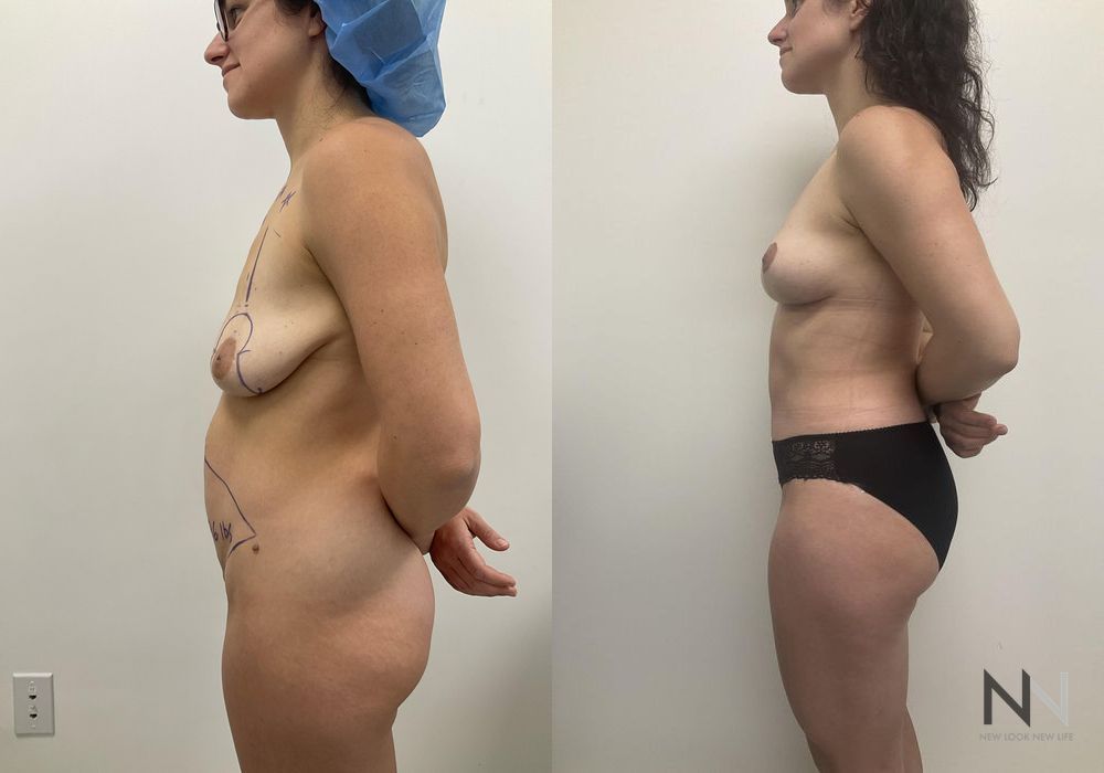 Mommy Makeover - Thumbnail 3