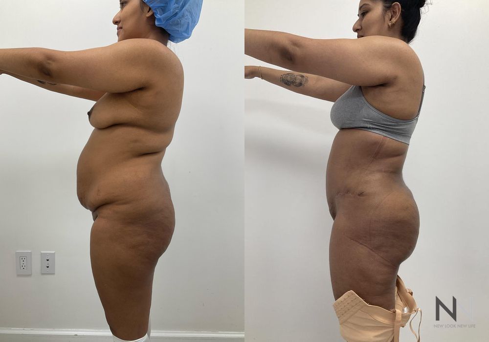 Mommy Makeover - Thumbnail 4