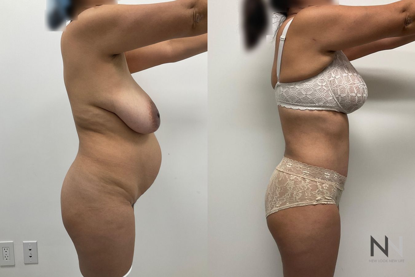 Before and after mommy makeover eight months results - Angle 3