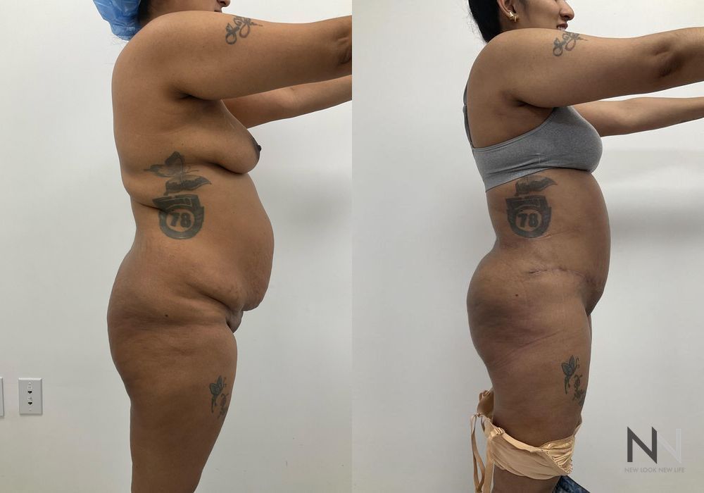 Mommy Makeover - Thumbnail 2