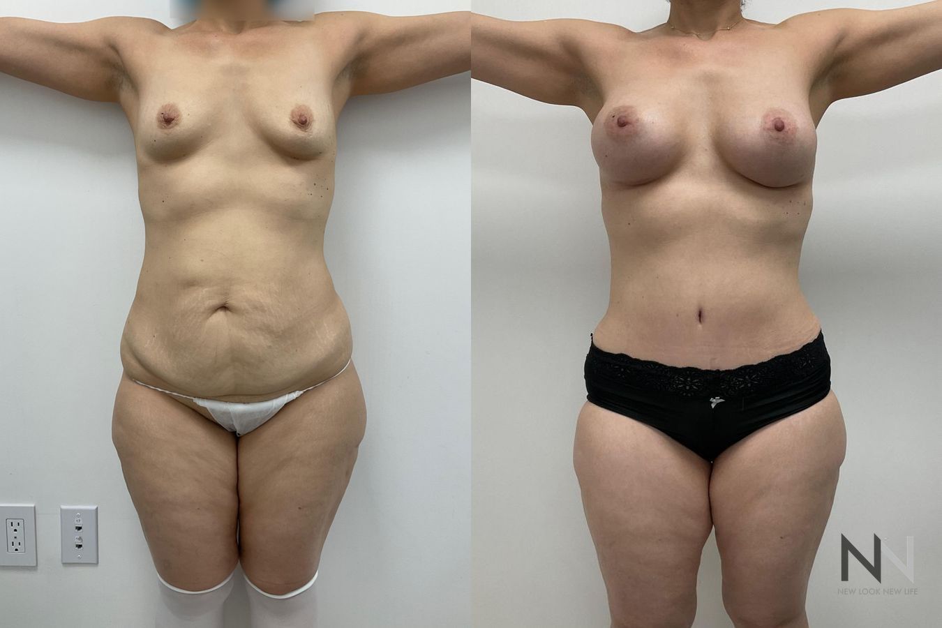 Breast augmentation and body contouring before and after