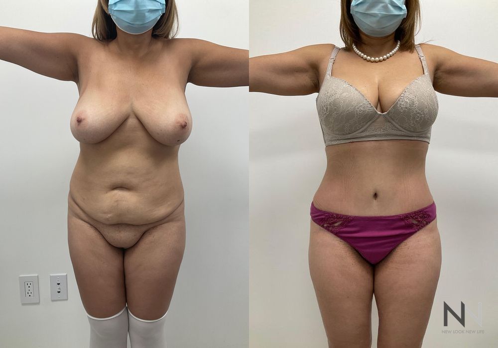 Mommy Makeover - Thumbnail 3