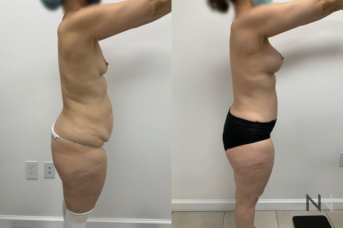 Breast augmentation and body contouring before and after - Angle 4