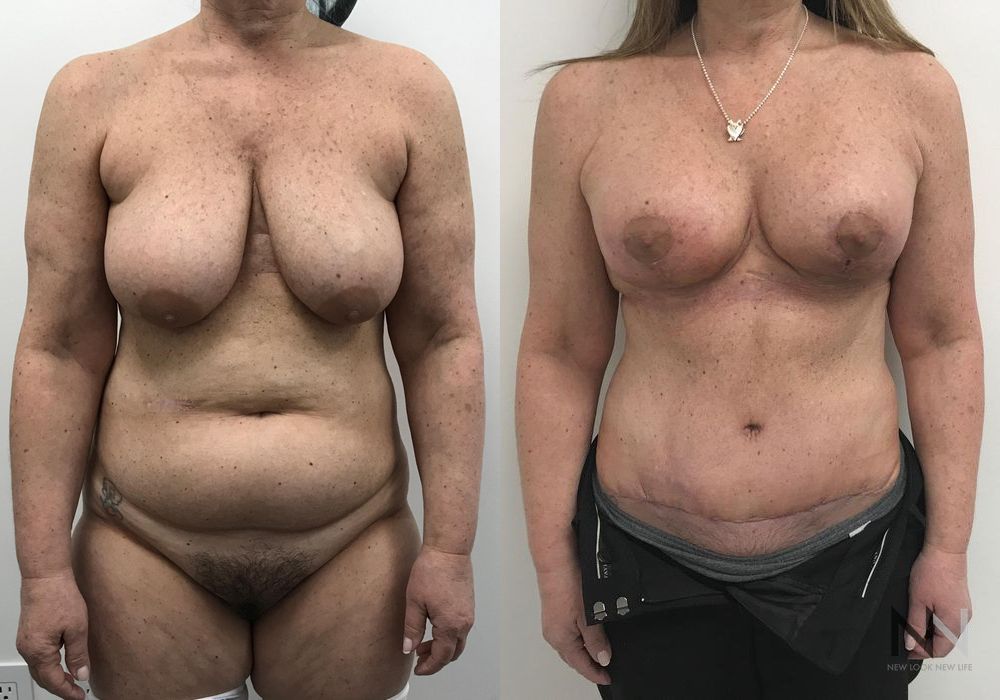 Mommy Makeover - Thumbnail 3