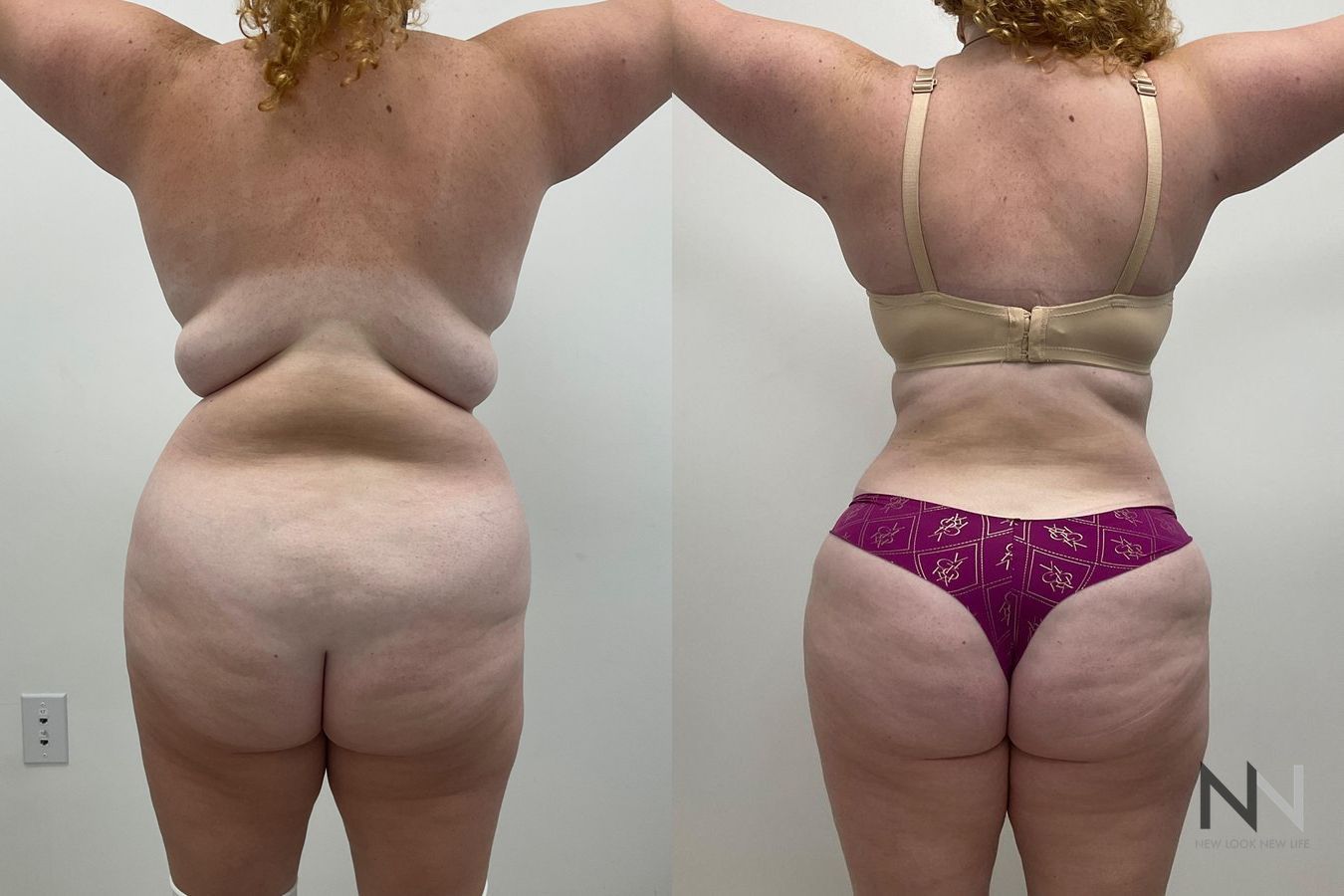 Abdominal contour improvement after mommy makeover - Angle 2