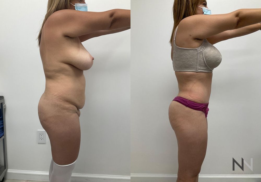 Mommy Makeover - Thumbnail 4