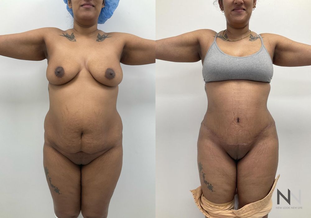 Mommy Makeover - Thumbnail 3