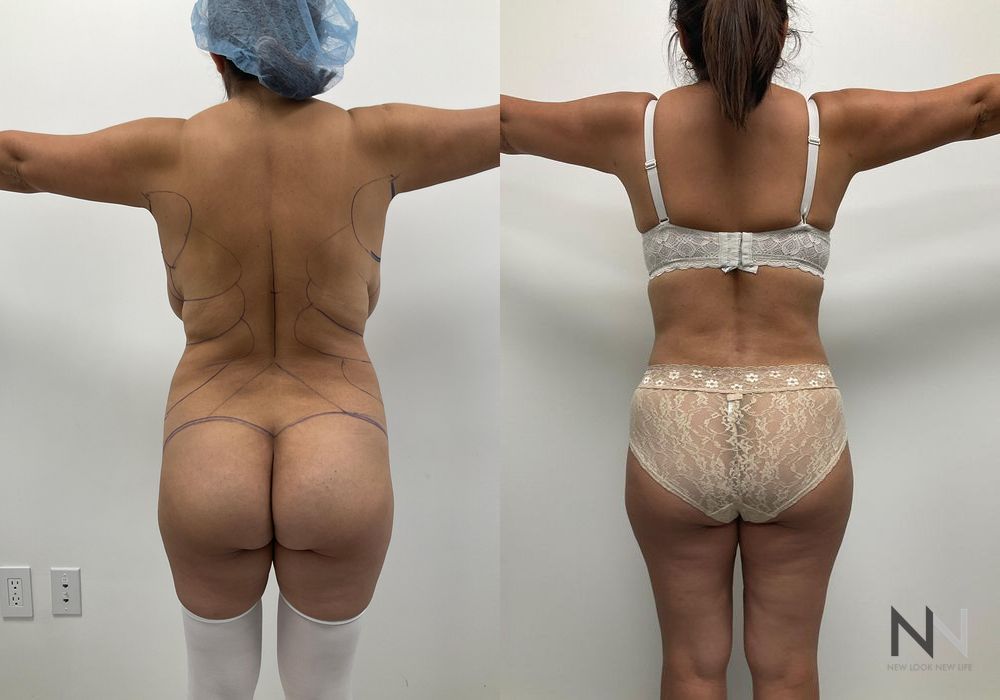 Mommy Makeover - Thumbnail 3