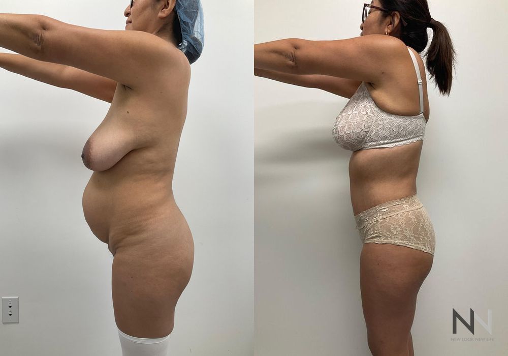 Mommy Makeover - Thumbnail 2