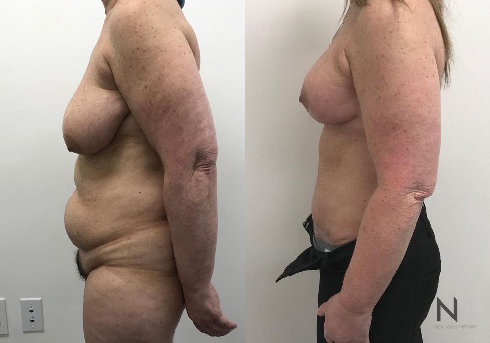 Mommy Makeover - Thumbnail 2