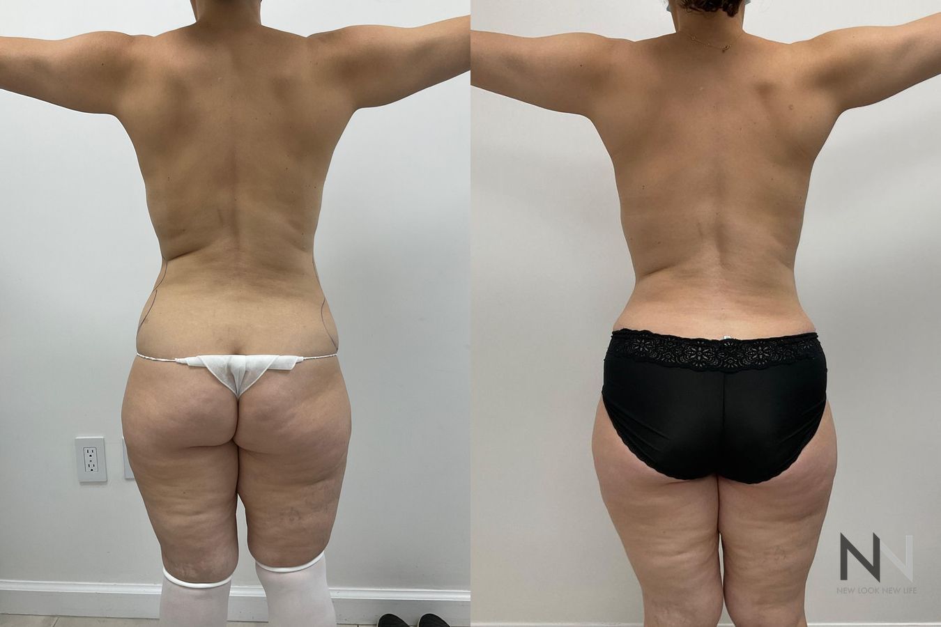 Breast augmentation and body contouring before and after - Angle 3