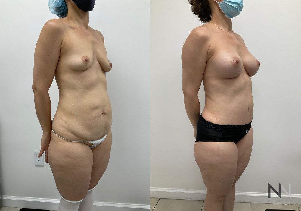 Mommy Makeover - Thumbnail 2