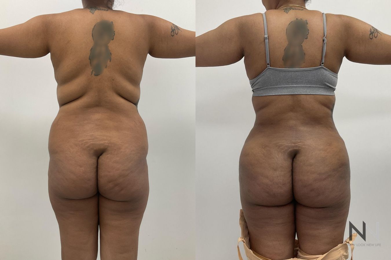 Before and after mommy makeover six months results - Angle 2