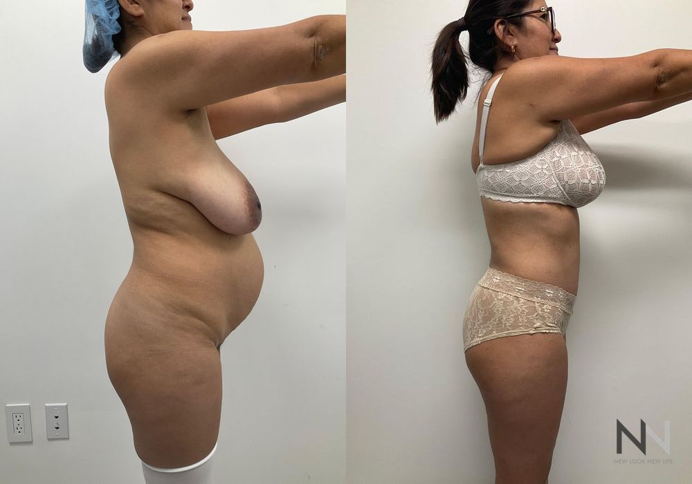 Mommy Makeover - Thumbnail 4