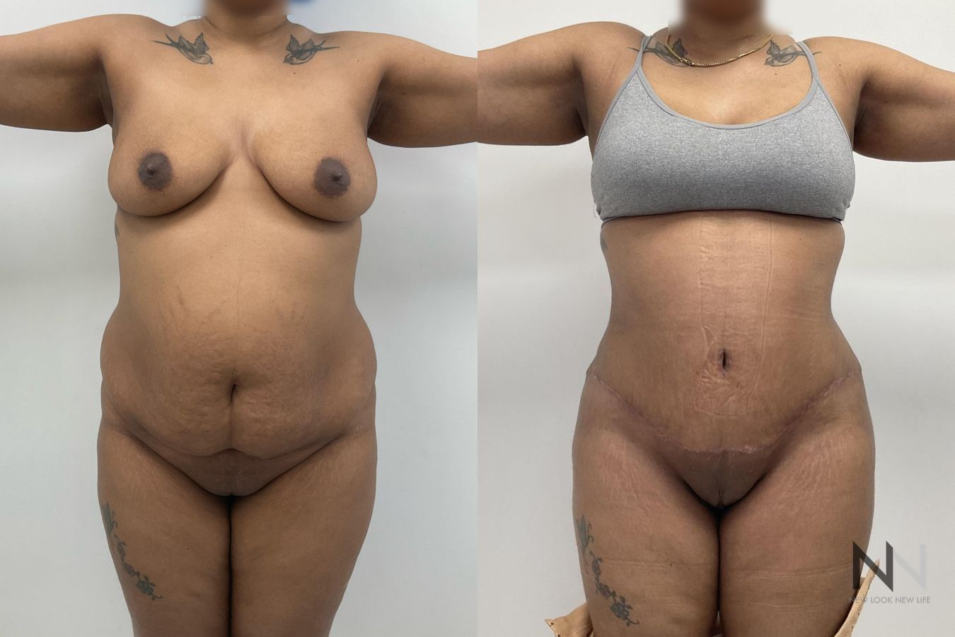 Before and after mommy makeover six months results