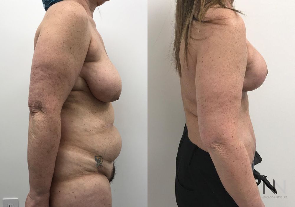 Mommy Makeover - Thumbnail 5