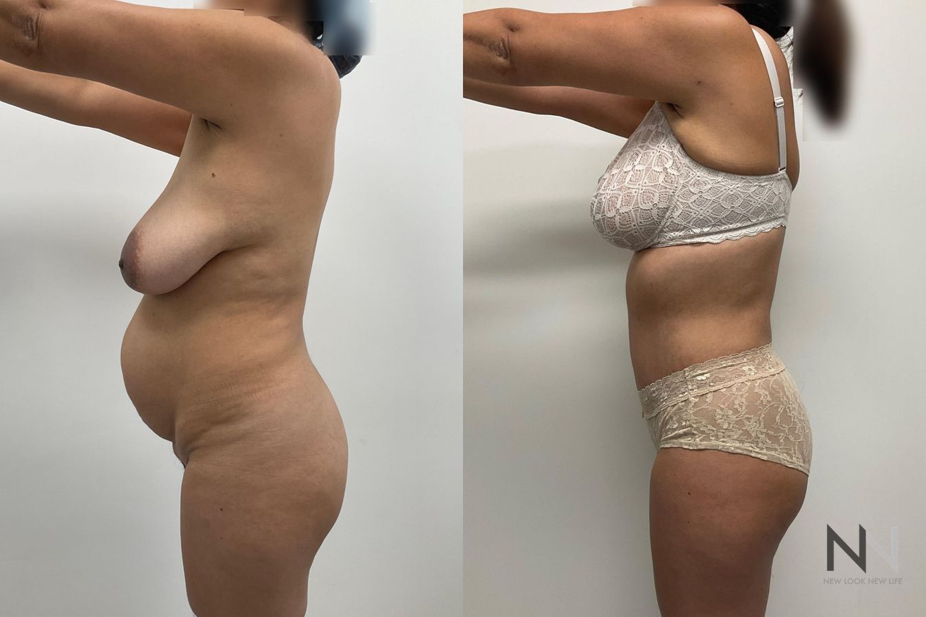 Before and after mommy makeover eight months results - Angle 4