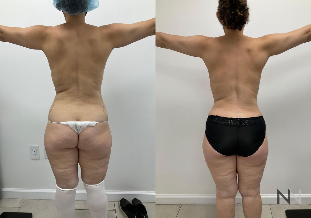 Mommy Makeover - Thumbnail 3