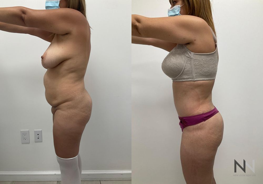 Mommy Makeover - Thumbnail 2