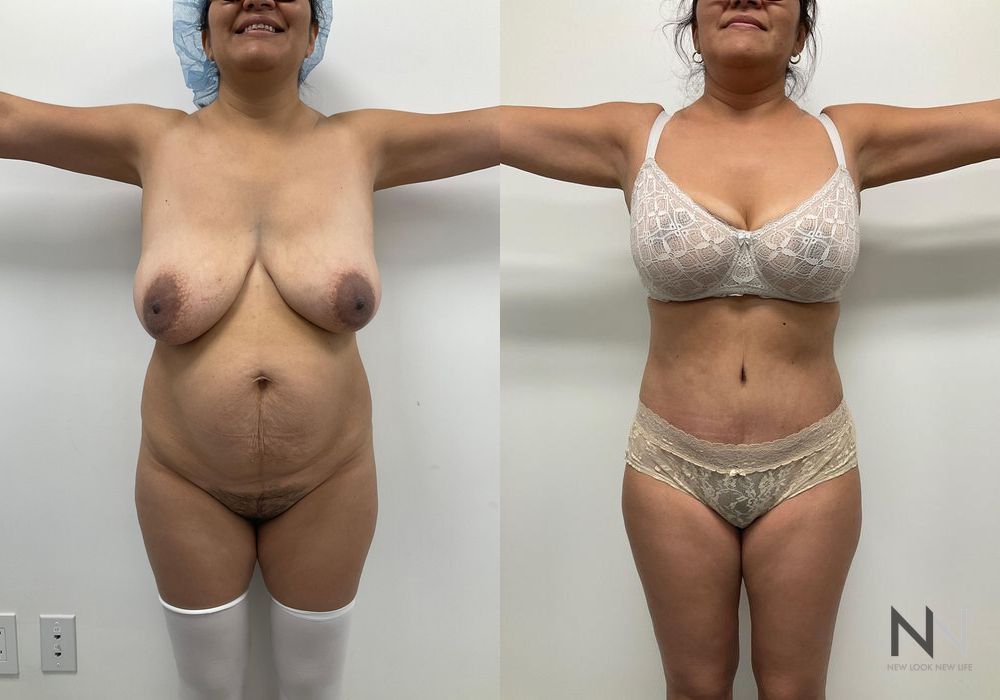 Mommy Makeover - Case 1894