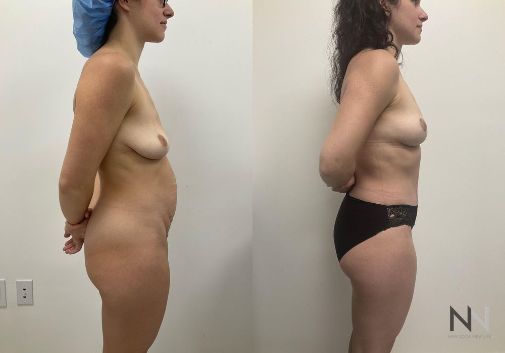 Mommy Makeover - Thumbnail 2