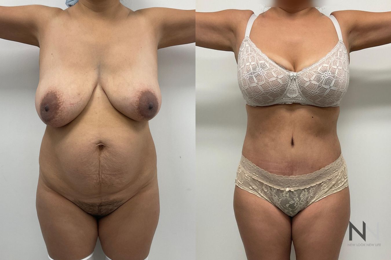 Before and after mommy makeover eight months results