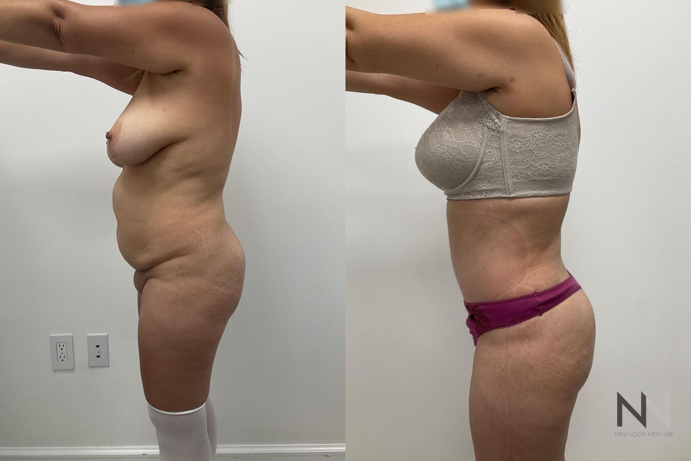 Abdominoplasty results showing improved abdominal contour - Angle 3